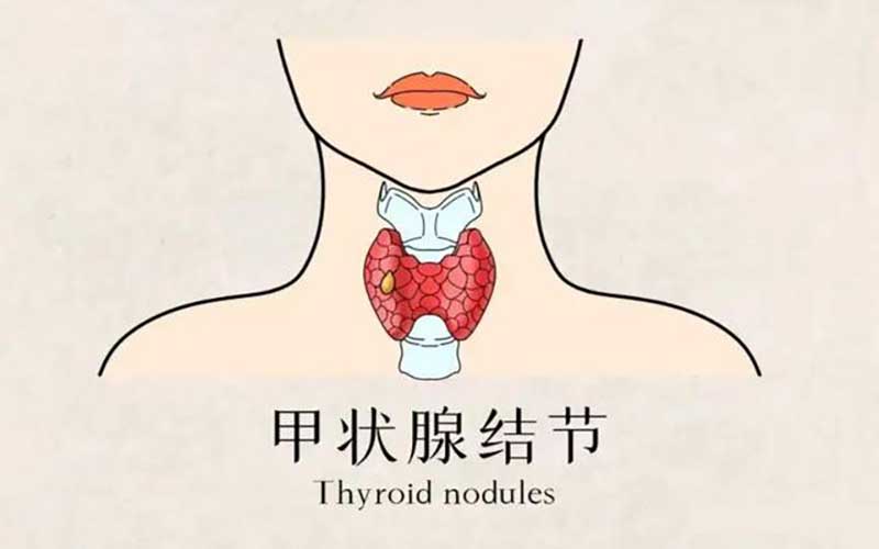 按揉八穴助甲状腺结节消解