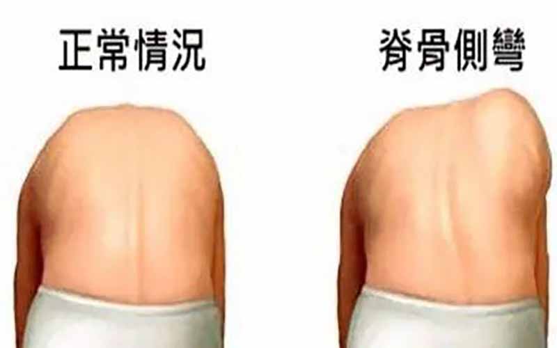 青少年特发性脊柱侧凸治未病干预指南